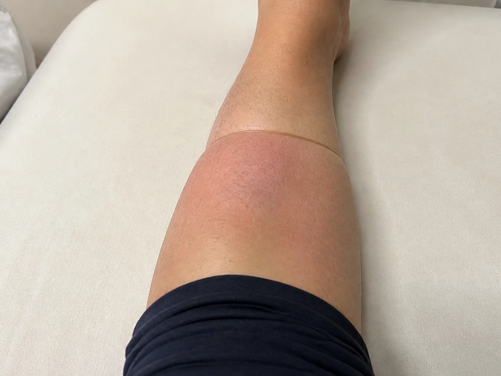 Close-up of a leg with a tight band causing mild swelling and redness below it